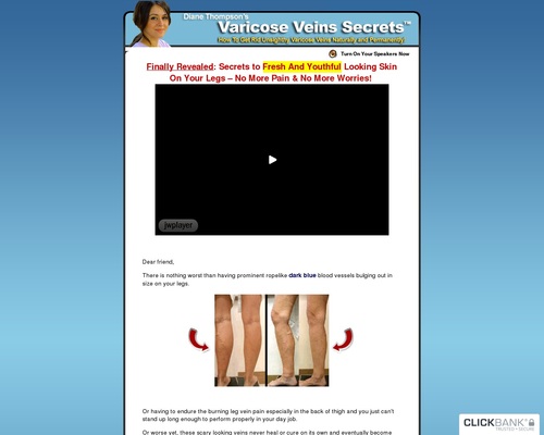 Varicose Veins Natural Alternative Home Remedies, Herbal & Treatment Help – Spider Veins Cure Ways post thumbnail image